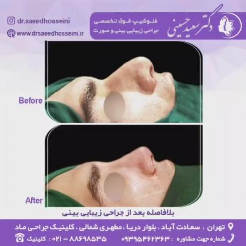 جراحی-زیبایی-بینی-63
