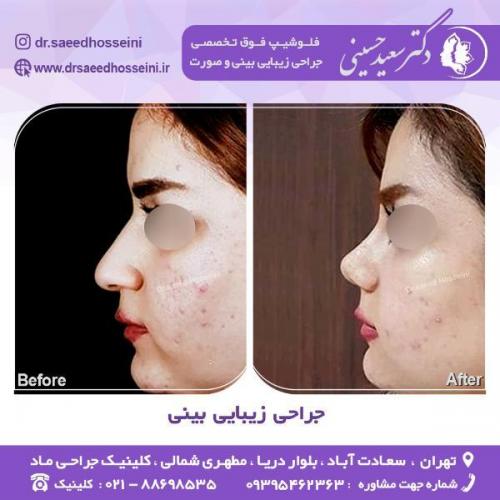 جراحی-زیبایی-بینی-65