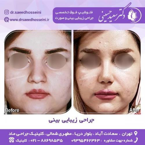 جراحی-زیبایی-بینی-66