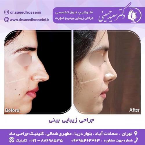 جراحی-زیبایی-بینی-67