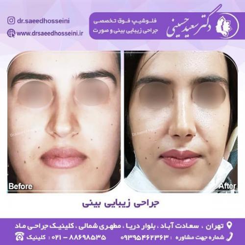 جراحی-زیبایی-بینی-68
