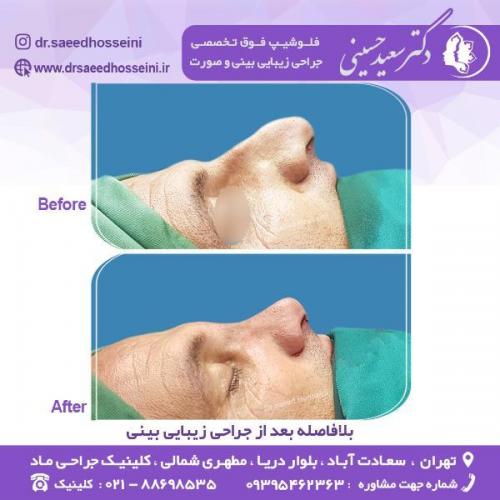 جراحی-زیبایی-بینی-69