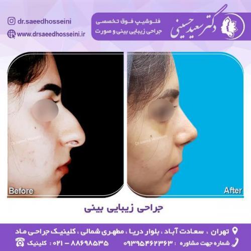 جراحی-زیبایی-بینی-70