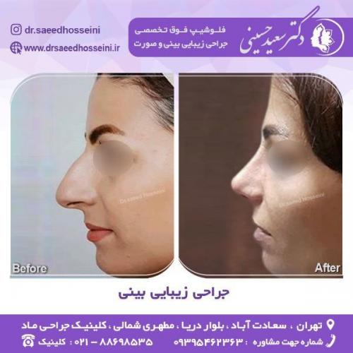 جراحی-زیبایی-بینی-71