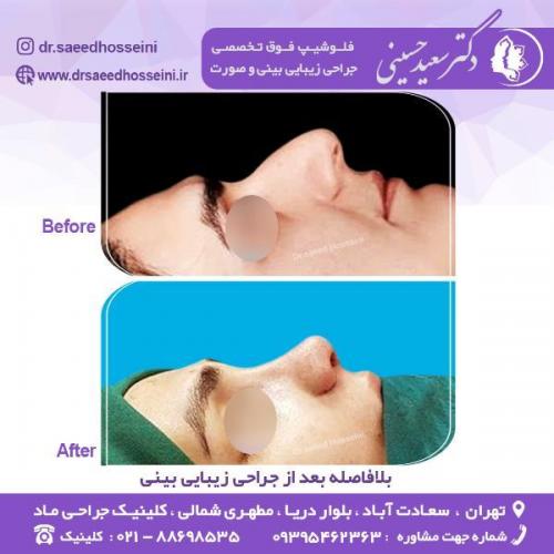 جراحی-زیبایی-بینی-72