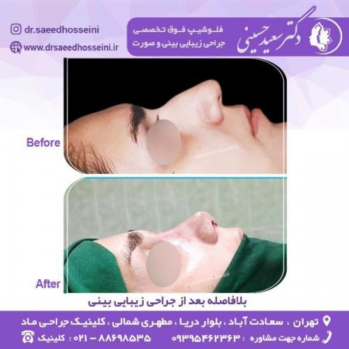 جراحی-زیبایی-بینی-73