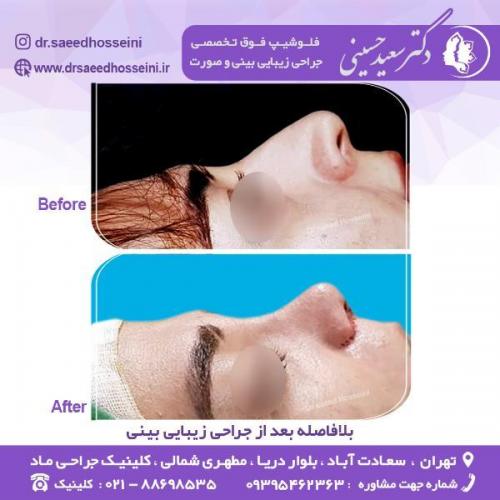 جراحی-زیبایی-بینی-74