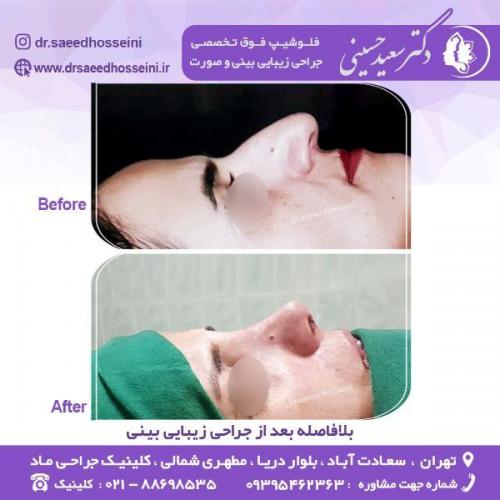 جراحی-زیبایی-بینی-75