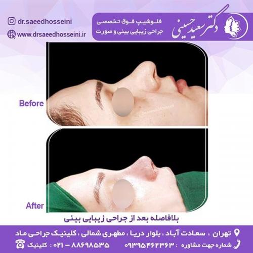 جراحی-زیبایی-بینی-82
