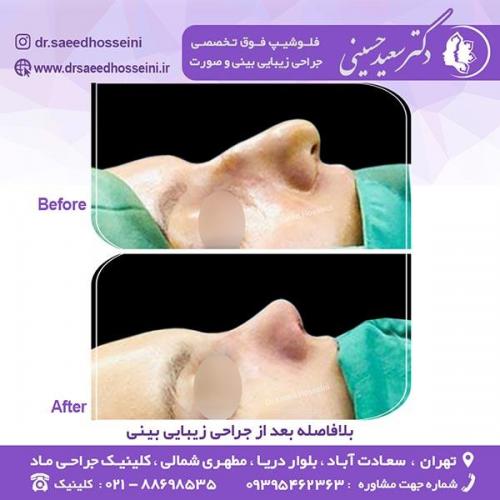 جراحی-زیبایی-بینی-83