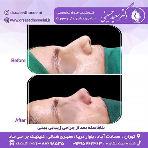 جراحی-زیبایی-بینی-84