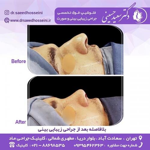 جراحی-زیبایی-بینی-86