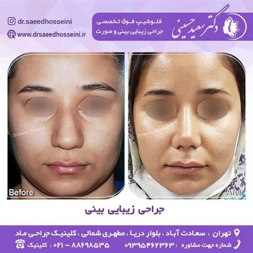 جراحی-زیبایی-بینی-93