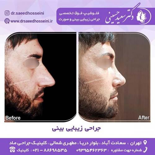 جراحی-زیبایی-بینی-94
