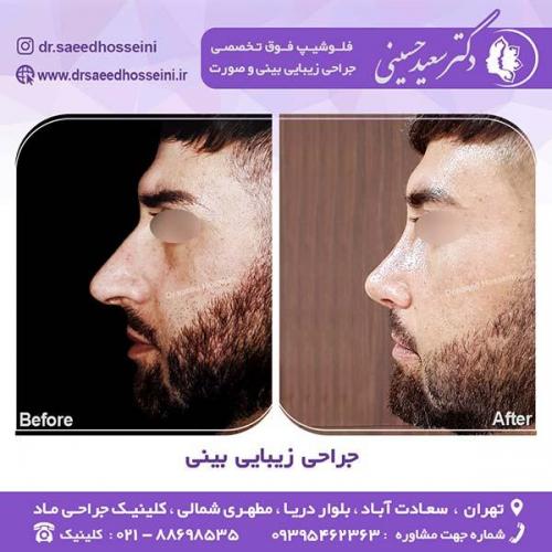 جراحی-زیبایی-بینی-95