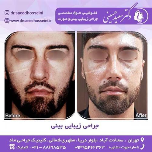 جراحی-زیبایی-بینی-96