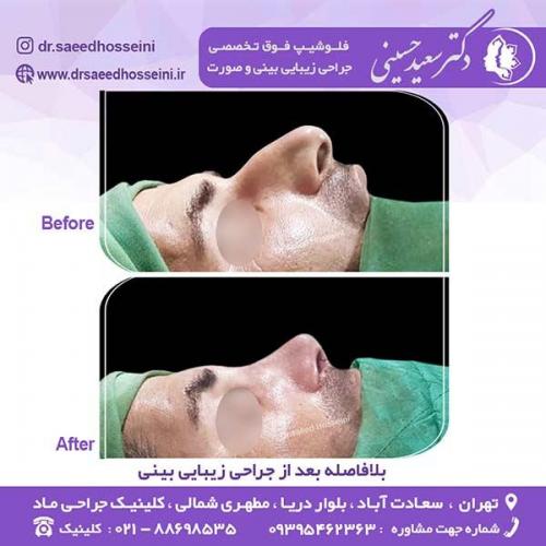 جراحی-زیبایی-بینی-98