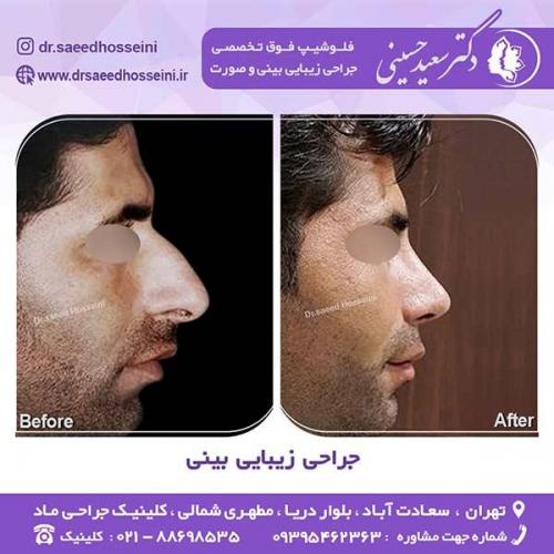 جراحی-زیبایی-بینی-99