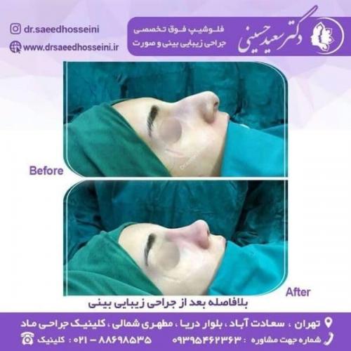 جراحی زیبایی بینی 150 (1)