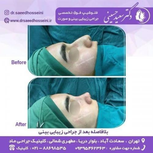 جراحی زیبایی بینی 150 (10)