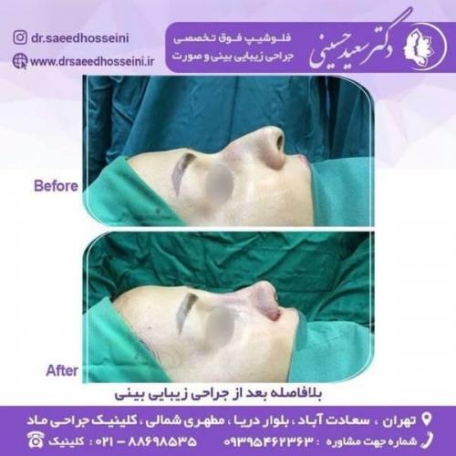 جراحی زیبایی بینی 150 (11)
