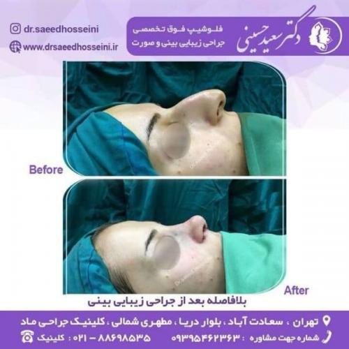 جراحی زیبایی بینی 150 (2)