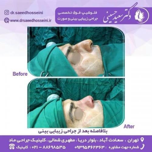 جراحی زیبایی بینی 150 (3)