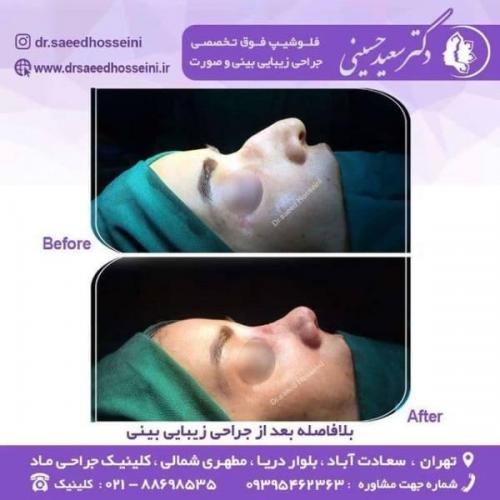 جراحی زیبایی بینی 150 (4)