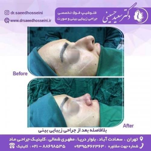 جراحی زیبایی بینی 150 (5)