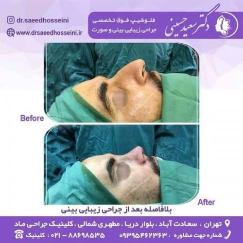 جراحی زیبایی بینی 150 (6)