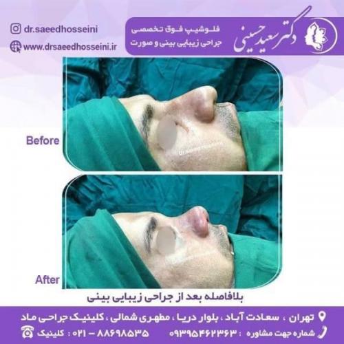 جراحی زیبایی بینی 150 (9)